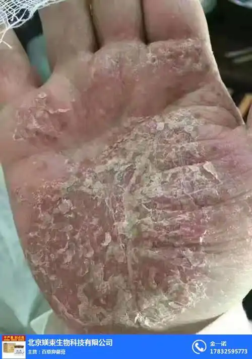 手上有小红点-手上有小红点疼