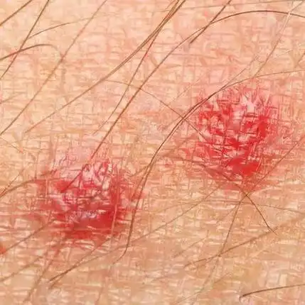 毛囊炎|痘痘|抓挠_网易订阅