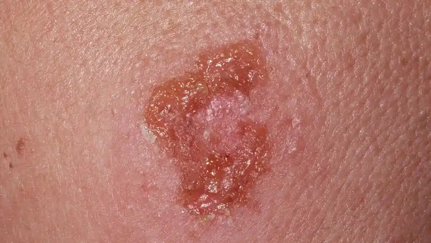 随着天气逐渐变得炎热,小朋友皮肤难免会出现一些小丘疹,小水疱,但是