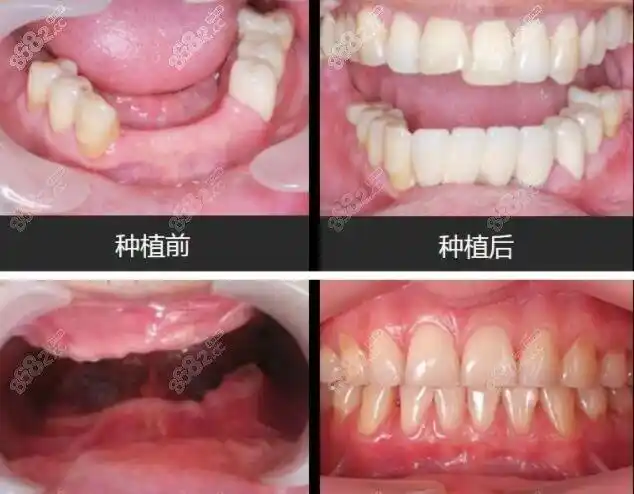 全口种植牙实例 图源www.8682.cc