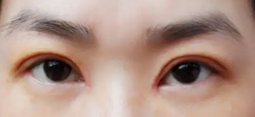 我的双眼皮手术十天分享希望能给大家帮助