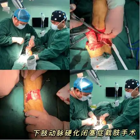 考虑在增加远端血供后,可降低截肢平面,保留更多肢体组织,再行远端