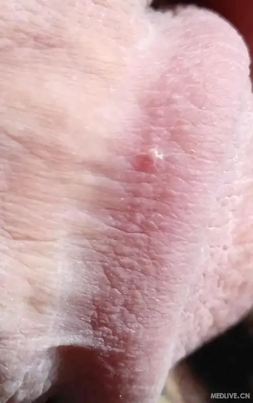 这是阴囊湿疹吗