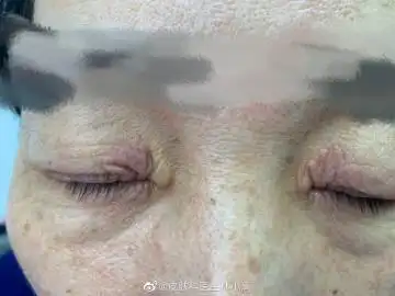 来自皮肤科医生林小清 - 微博