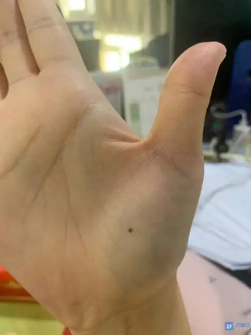 手心不知道什么时候长了一颗黑色痣,这会不会是黑色素瘤?