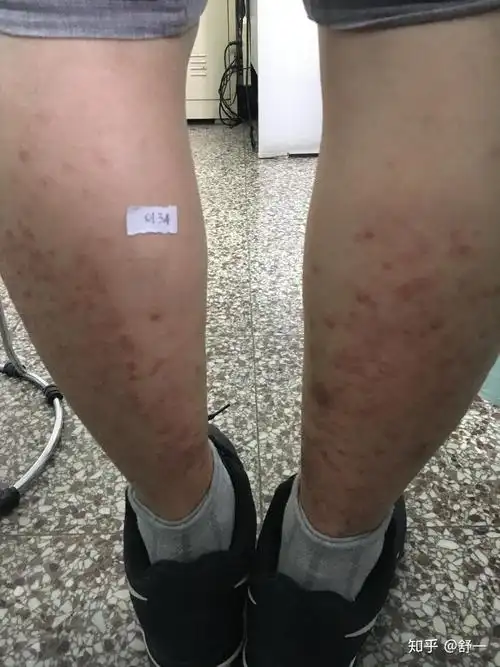 皮肤科医生与你共同面对湿疹复发