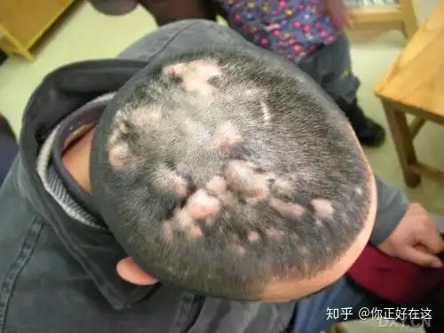 知乎大神们,头发里长毛囊炎怎么办. - 知乎