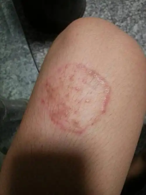 请问这个是什么皮肤病?