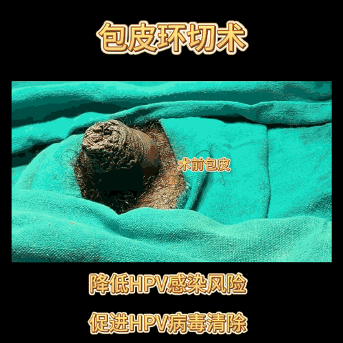 样算包皮过长给大家找了个包皮环切术前术后对比图#探秘hpv冷知识