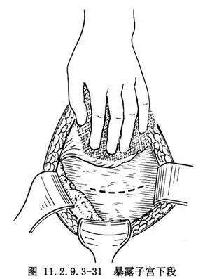 腹膜外剖宫产术