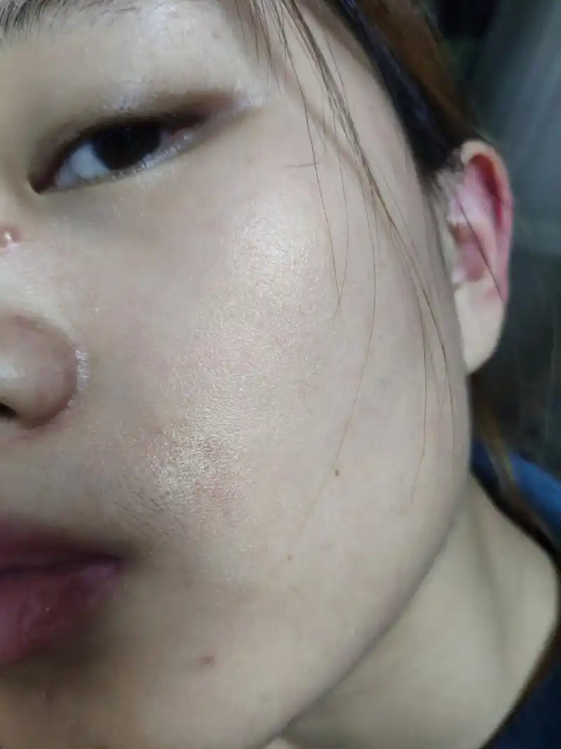 角质层受损 昨天是这样的