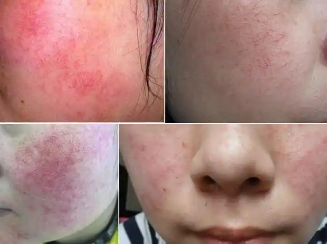 敏感肌肤怎样修复角质层?精简护肤之道,护肤越简单对皮肤越好~