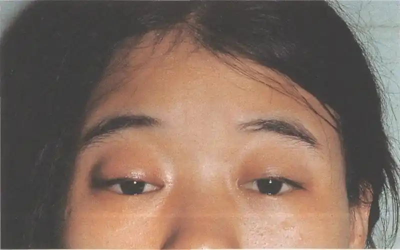 (图) 重症肌无力性上睑下垂
