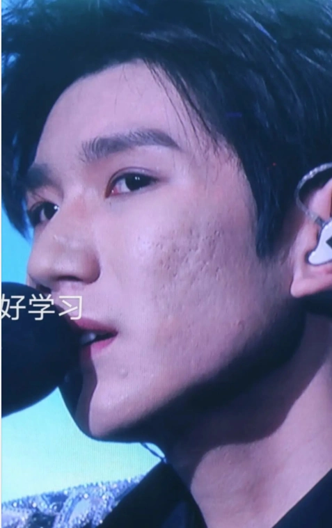 王源近照曝光,满脸痘印似大叔?小鲜肉翻车被嘲颜值下滑