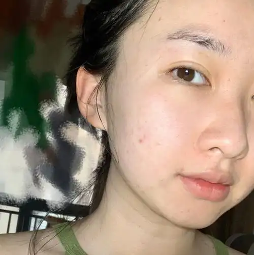 的图片没有美颜的有痘痘的照片熬夜痘长什么样冒痘暗沉熬夜皮肤暗沉