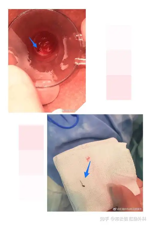 吻合器痔手术后的吻合钉去哪里了