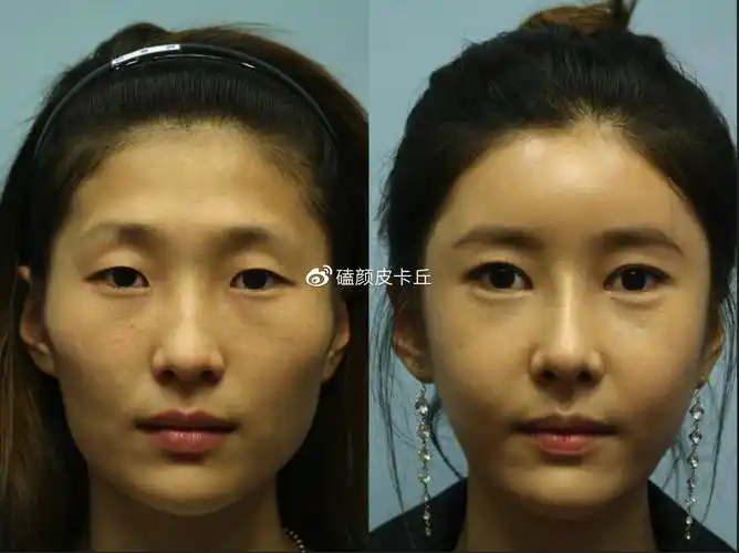 自体脂肪丰额头可以维持多久做填充手术有哪些需要注意的事情