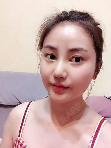 终于拆线啦恢复期真的是漫长的,每天都期待能变漂亮话不多说,先看照片