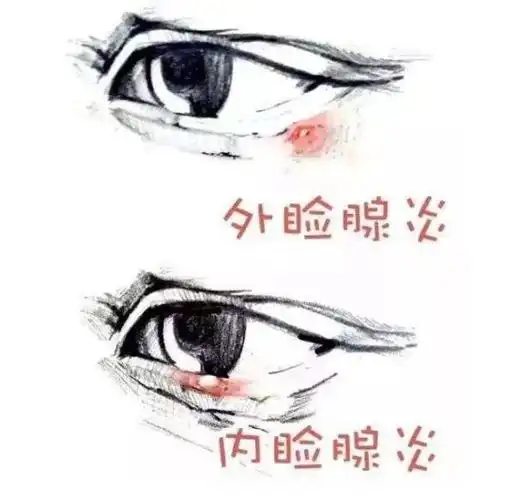 但是,眼睛上长小疙瘩就真的都是针眼吗?