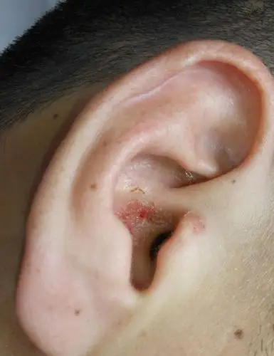 外耳道生疮,结痂,渗液 - 皮肤及性传播疾病讨论版 - 爱爱医医学论坛