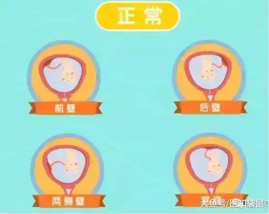 (3)胎盘臀位分为以下四种情况:左骶前(lsa),左骶后(lsp),右骶前(rsa)