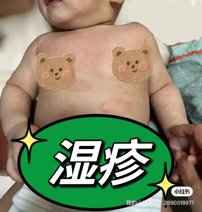 宝宝92湿疹痊愈7515只需做对这几步7515.