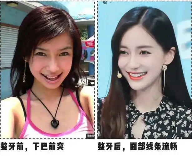 整牙=换张脸?尤其是有这2个特点的女生!