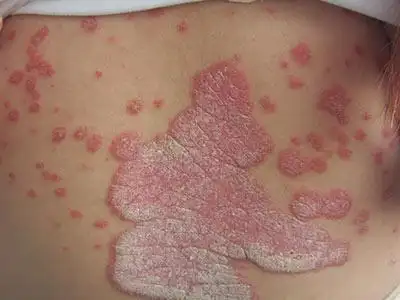 真实案例,,通过治疗成功摆脱牛皮癣困扰-济南天大皮肤病研究院-全民