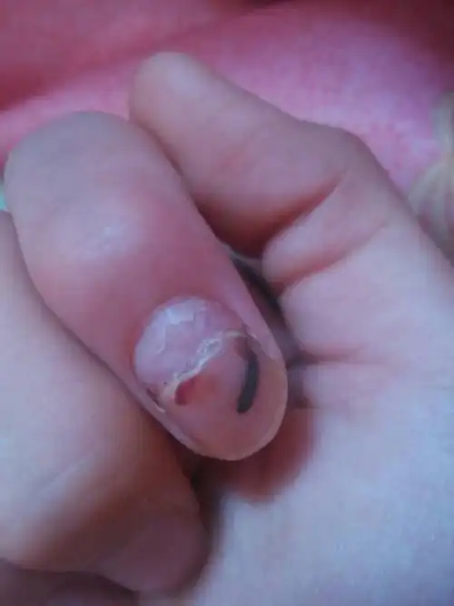 指甲外伤掉了成这样了,过了一个月,如果掉了该如何处理?