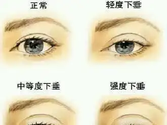【福州美贝尔——重症肌无力眼睑下垂症状】