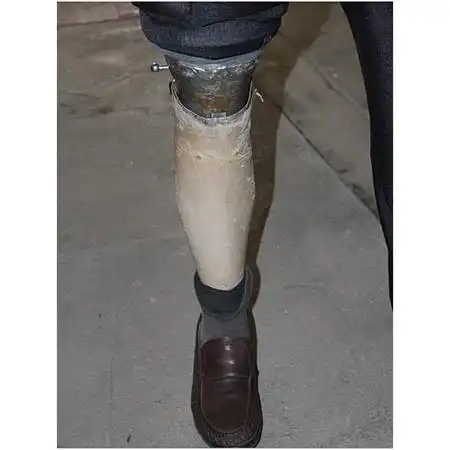 小腿假肢及踝离断假肢