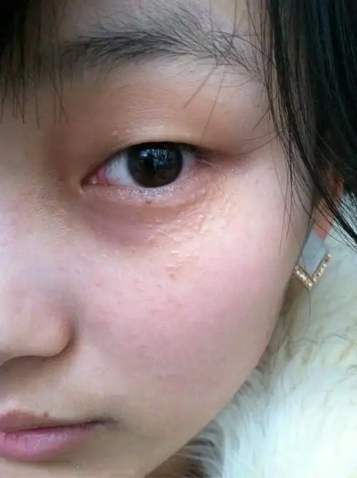 扁平疣初期症状图片