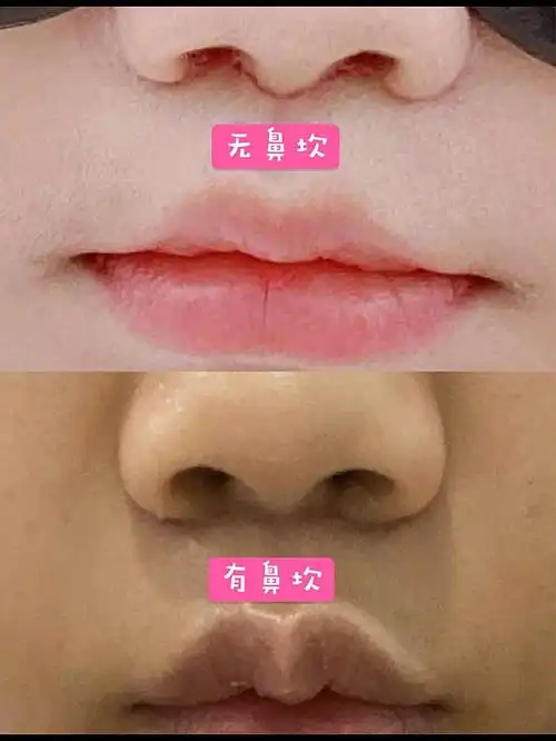 在专业的朋友的推荐下选择了靠谱的医院和医生做了这