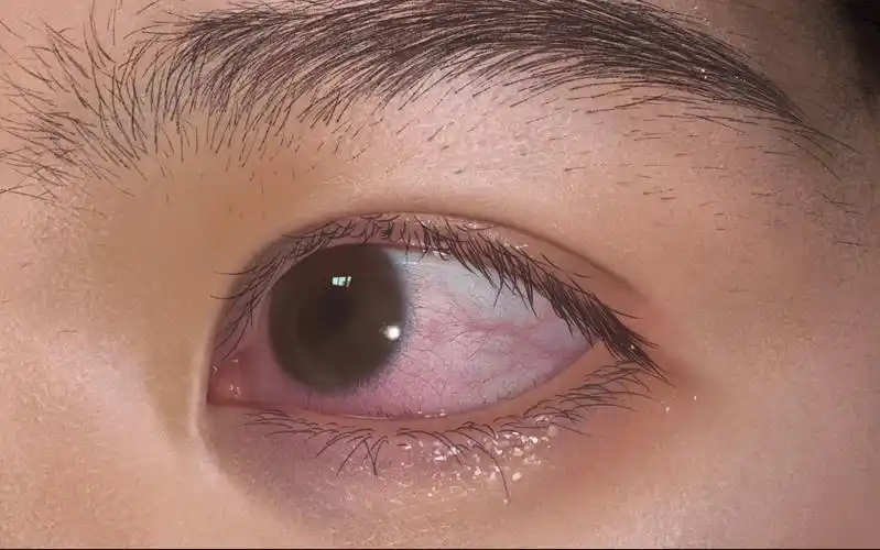 局部塑造添加亿点细节画一个充满红血丝的眼睛眼球和皮肤的质感处理