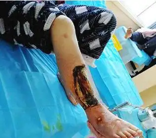 糖尿病足怎么办感染坏疽莱康新武器改变截肢命运