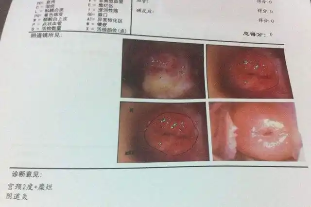 医生提醒:不想宫颈"受威胁",3件事提前注意,或能绕开宫颈癌_手机搜狐