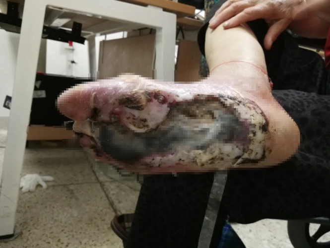 糖尿病足(溃疡,坏死)治疗经验分享——怎么让糖足患者远离截肢风险?