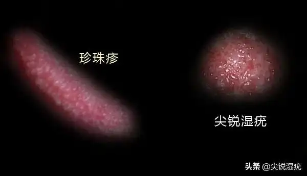 在日常生活中,有些男性发现自己冠状沟处出现了淡红色小丘疹,就怀疑是