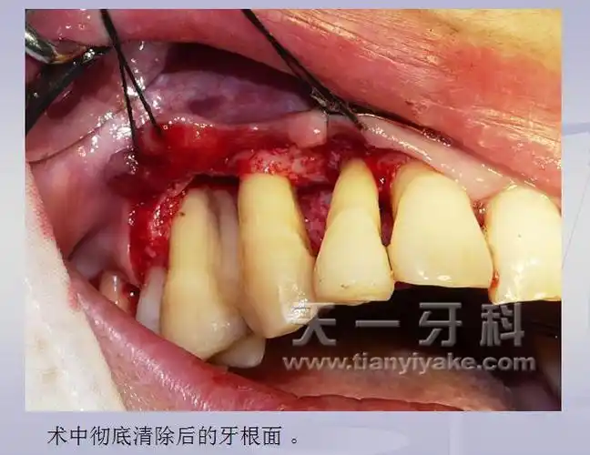 牙周翻瓣植骨手术示例