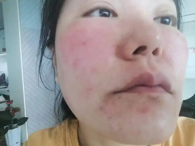 皮肤严重过敏红肿胀