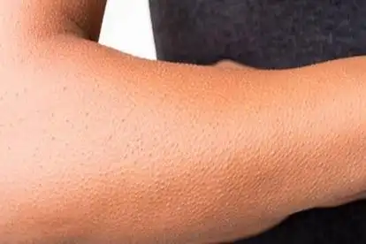 角质层较厚图片