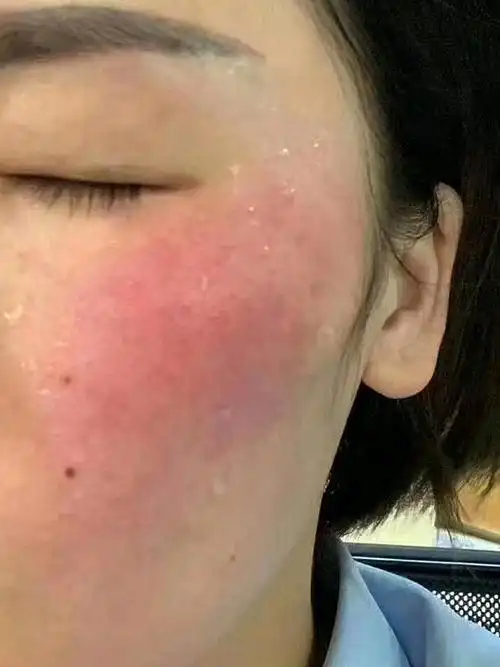 如何治疗敏感红血丝?