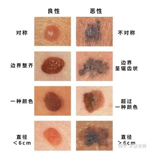 聊一聊痣 - 知乎