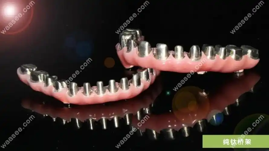 种植修复结构,你可以把它理解为一种桥架,是用搭桥的方式将缺失的牙齿