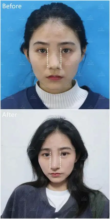 只想单纯的缩小鼻翼,为啥却做了个鼻综合【昆明美莱】
