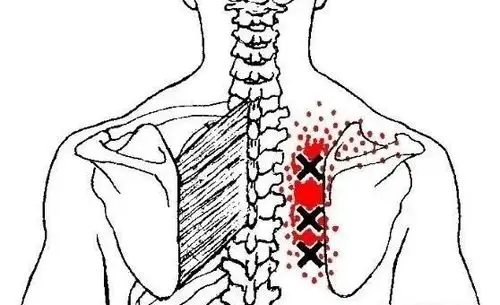 肩胛骨内侧缘痛的简单分析