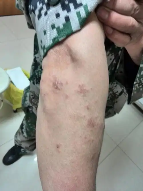 全身瘙痒性皮疹查因