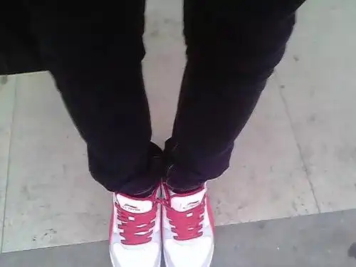 内八字:风湿性关节炎