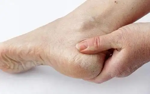 为何有的人脚后跟经常干裂原因中或许你也有还好我知道早