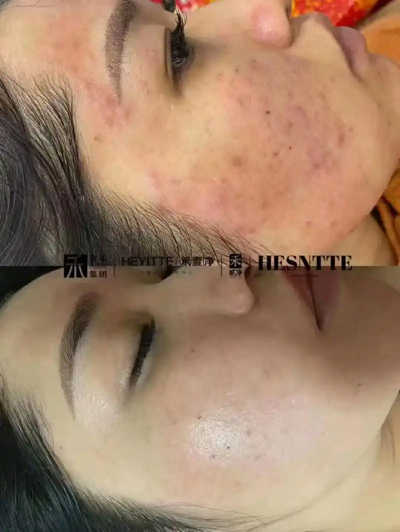 禾壹净祛痘阻断术反馈.#美容院加盟配合毛囊清洁定期疏通,搭 - 抖音